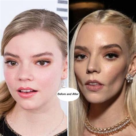 anya taylor-joy before and after surgery